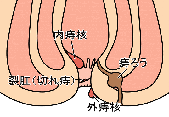 脱出した痔核を管理する方法